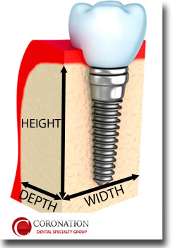 Height, Width, and Depth of Bone around a Dental Implant